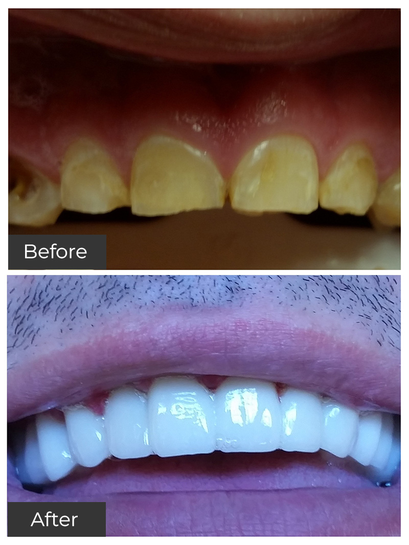 21st Century Dental Care | Dental Implants, Invisalign reg  and Veneers