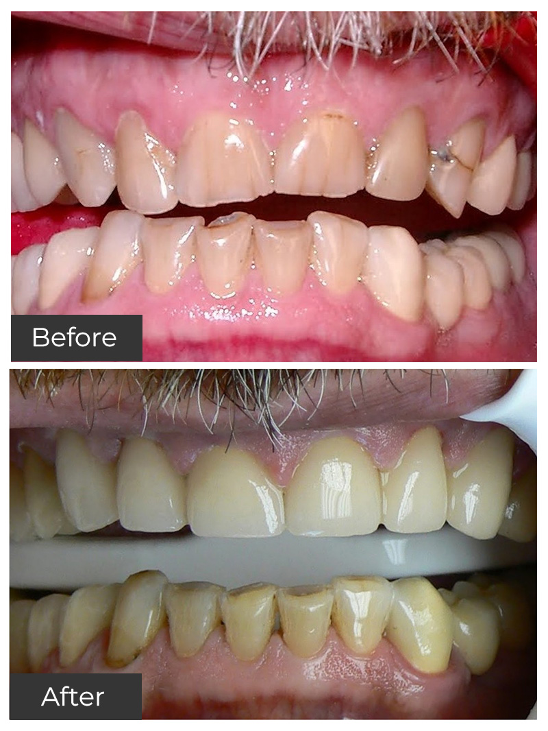 21st Century Dental Care Smile Gallery Periodontal Care Root Canal