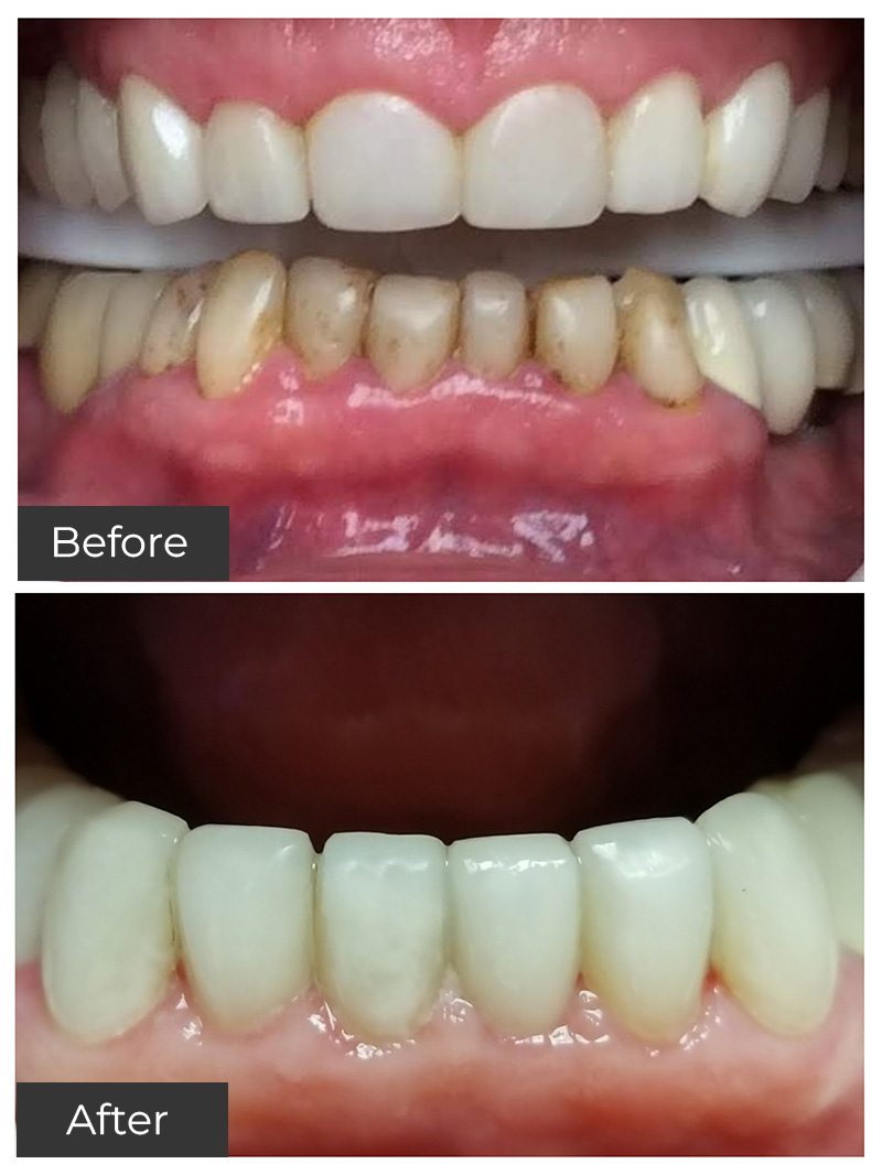 21st Century Dental Care | Porcelain Dental Crowns, Preventive Care and Teeth Whitening